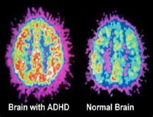 Is ADHD a legitimate condition or is it used as an excuse for not completing tasks?